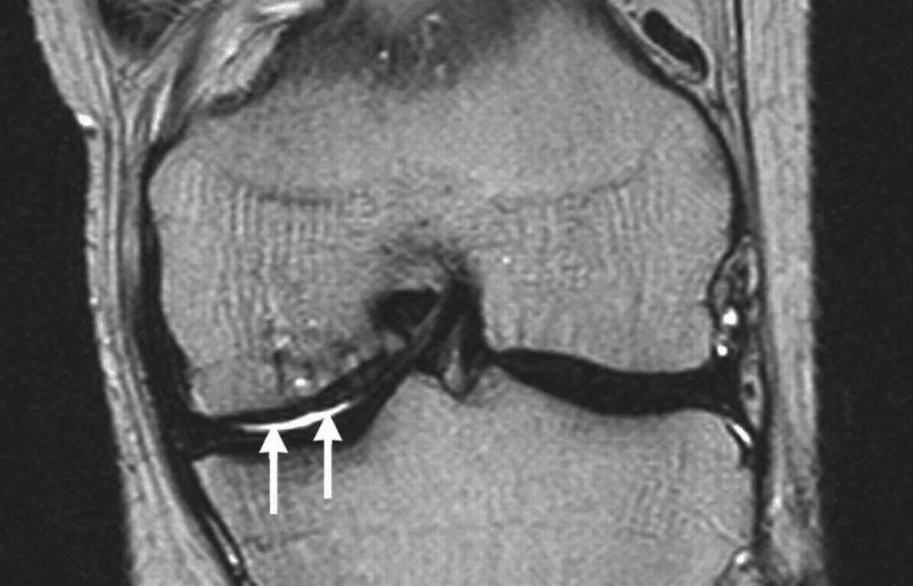 An MRI scan showing knee joint cartilage deterioration